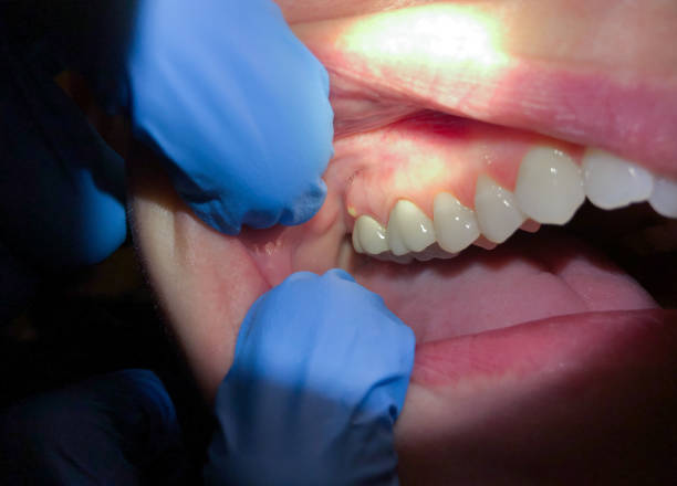 Best Emergency Treatment for Dental Infections or Abscesses in Walker, MI